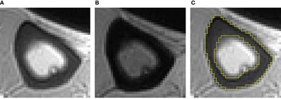 CKD Stages, Bone Metabolism Markers, and Cortical Porosity Index: Associations and Mediation Effects Analysis